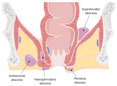 Perianal And Perirectal Abscess Concise Medical Knowledge