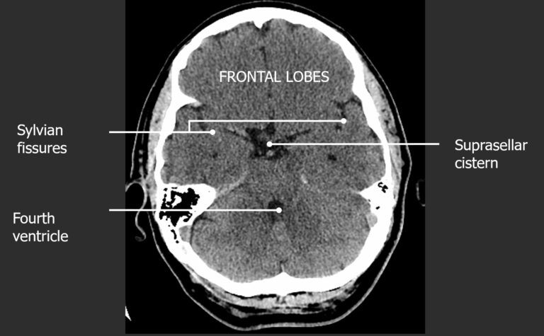 Imagenolog A De La Cabeza Y El Cerebro Concise Medical Knowledge