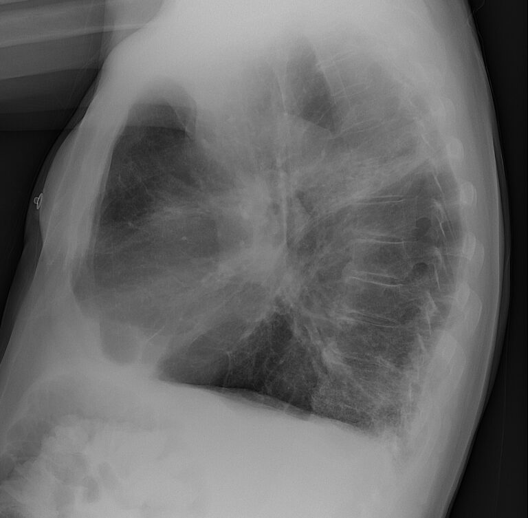 Doença Pulmonar Obstrutiva Crónica DPOC Concise Medical Knowledge