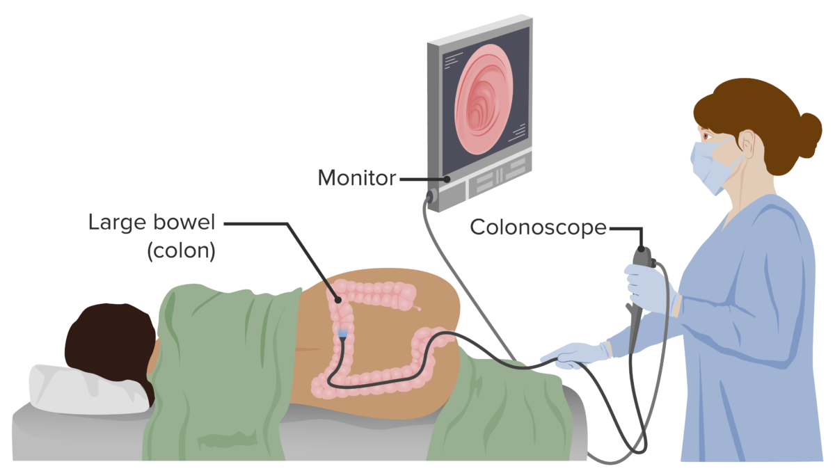 Colorectal Cancer Screening Concise Medical Knowledge