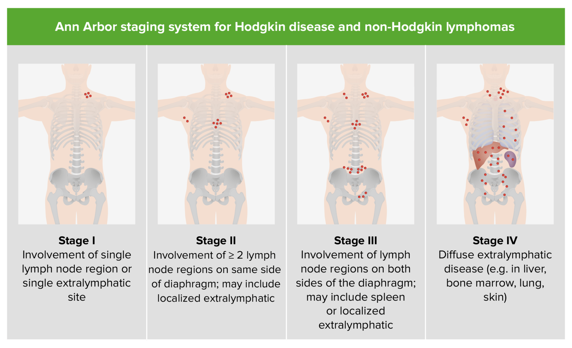 Linfoma De Hodgkin Concise Medical Knowledge