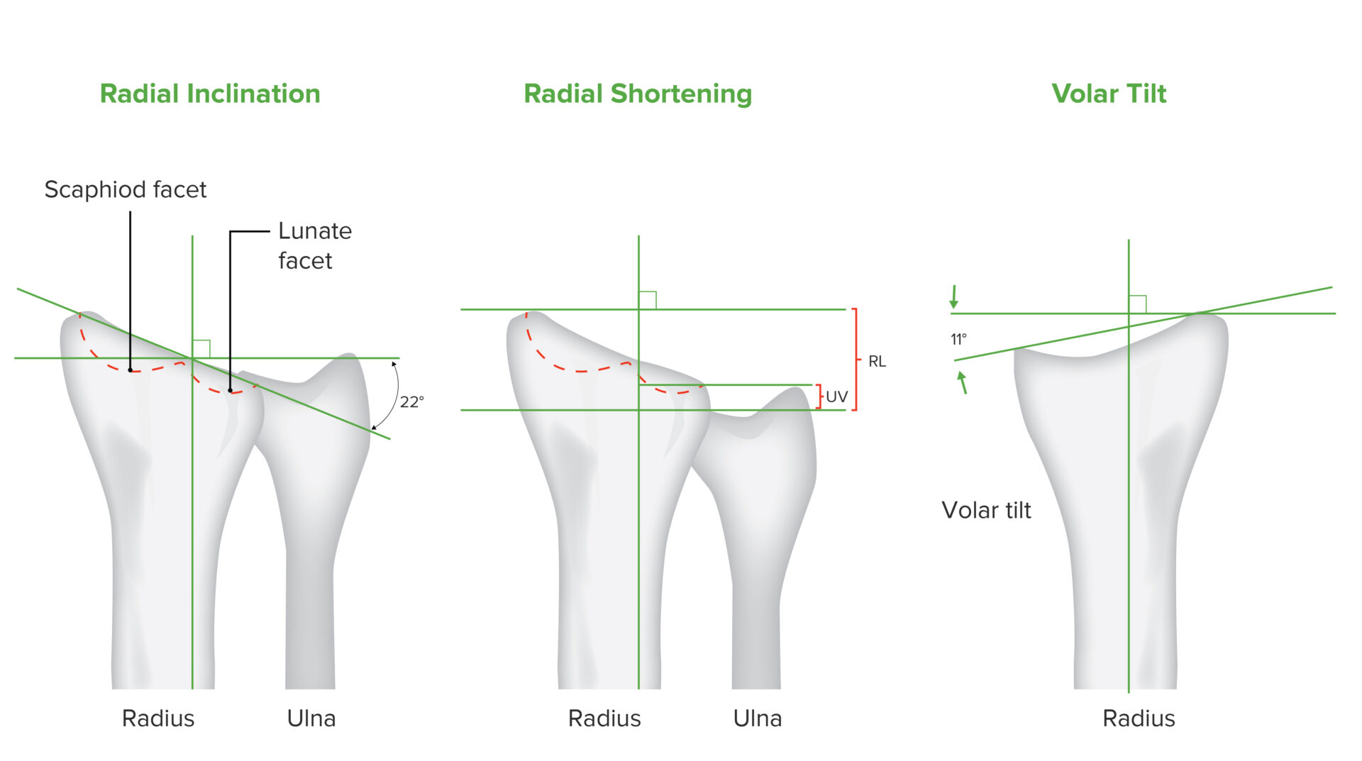 Fracturas De Radio Distal Concise Medical Knowledge