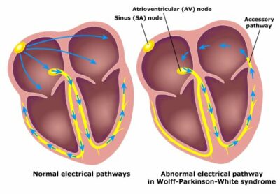 Taquicardias Supraventriculares Concise Medical Knowledge