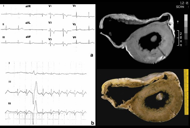 Electrocardiograma de 12 derivadas en miocardiopatía arritmogénica del ventrículo derecho