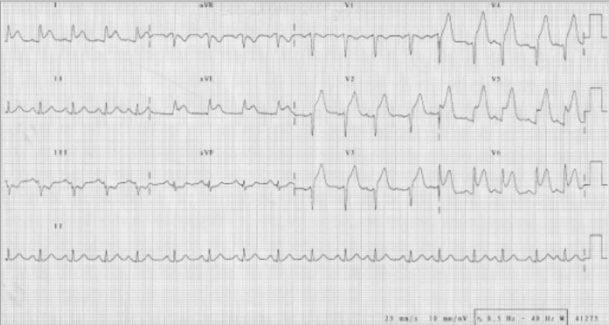12-lead electrocardiography on admission indicating an anterior st segment myocardial infarction