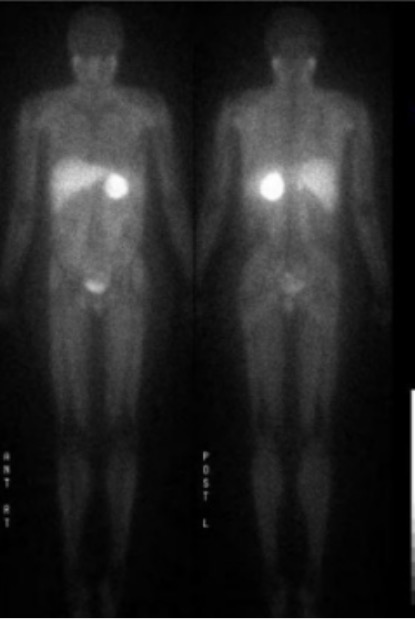 123i-mibg scan of pheochromocytoma