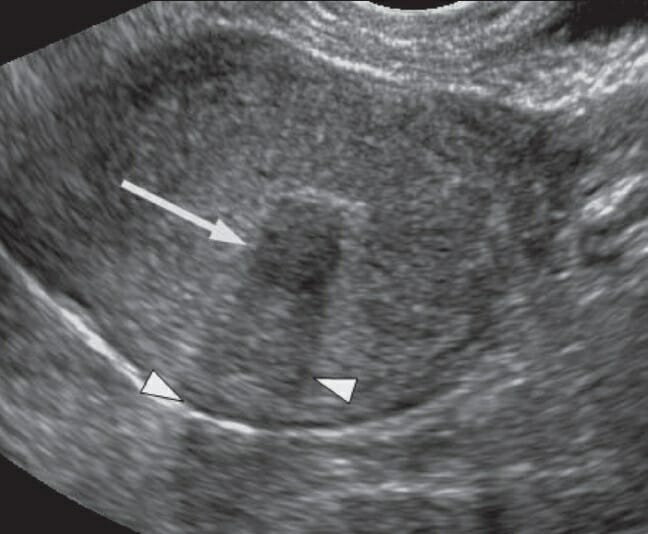 46-year-old woman with abdominal pain