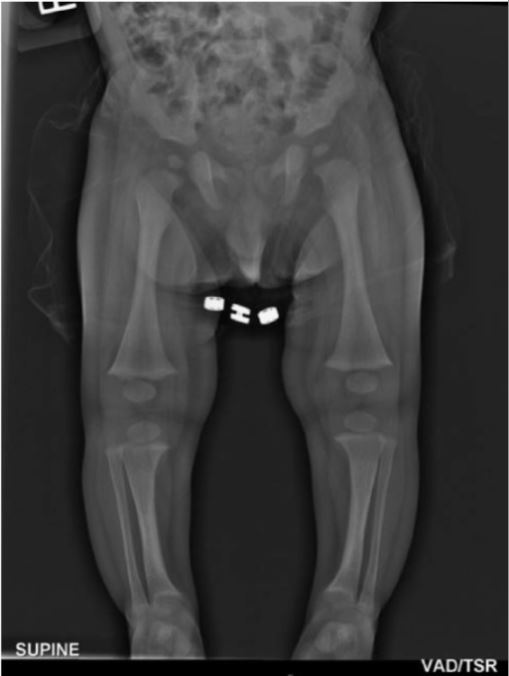 7-month-old infant with x-linked hypophosphatemic rickets