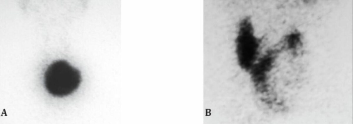 99mtco4 thyroid scan showing hot and cold nodule