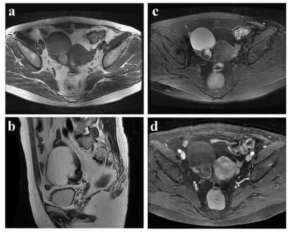 A 60-year-old female patient with a histologically proven hemorrhagic ovarian cyst
