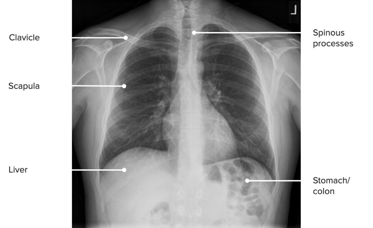 Una proyección pa del tórax que identifica las principales estructuras óseas del tórax y las principales estructuras de la parte superior del abdomen.