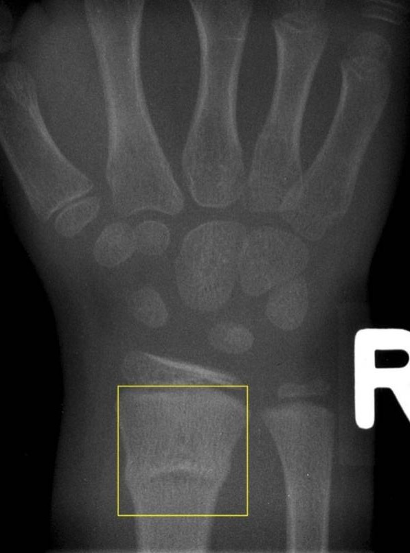 A buckle fracture of the distal radius