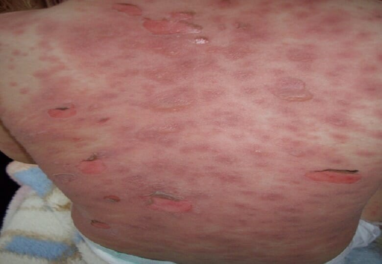 A case of steven-johnson syndrome after antibiotic use showing erythematous rash with flaccid blisters