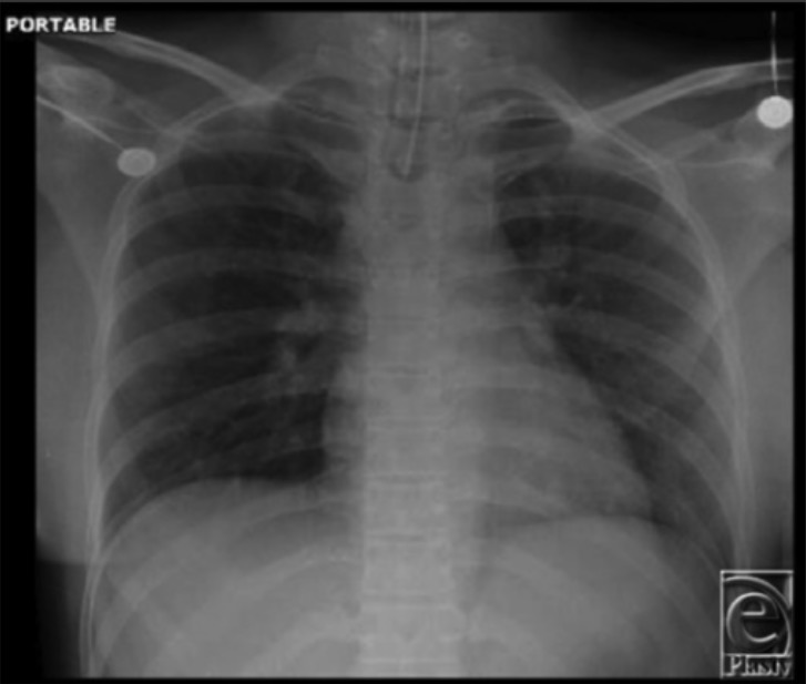 A chest x-ray showing correct endotracheal tube placement