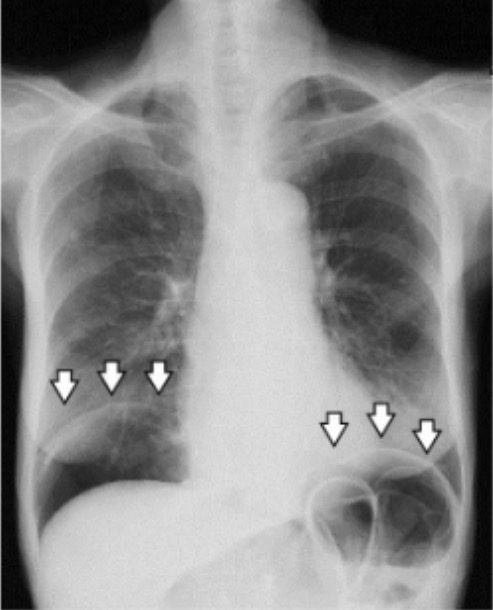 A chest radiograph demonstrating pneumoperitoneum