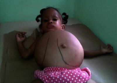 A child with massive hepatosplenomegaly due to Gaucher disease