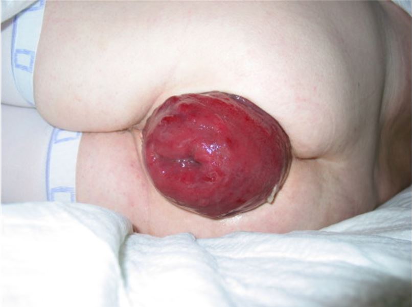 A full thicknes rectal prolapse