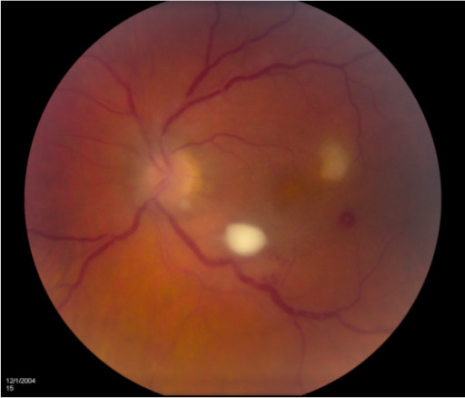 A fundoscopic examination of a patient with endogenous fungal endophthalmitis