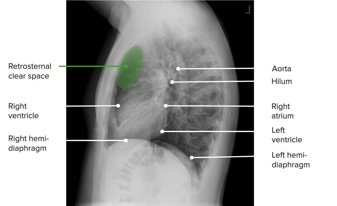 A lateral projection of the chest identifying the mediastinal structures