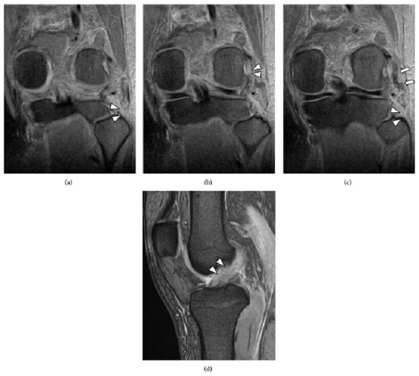 A multiple-ligament knee injury that includes posterolateral corner disruption