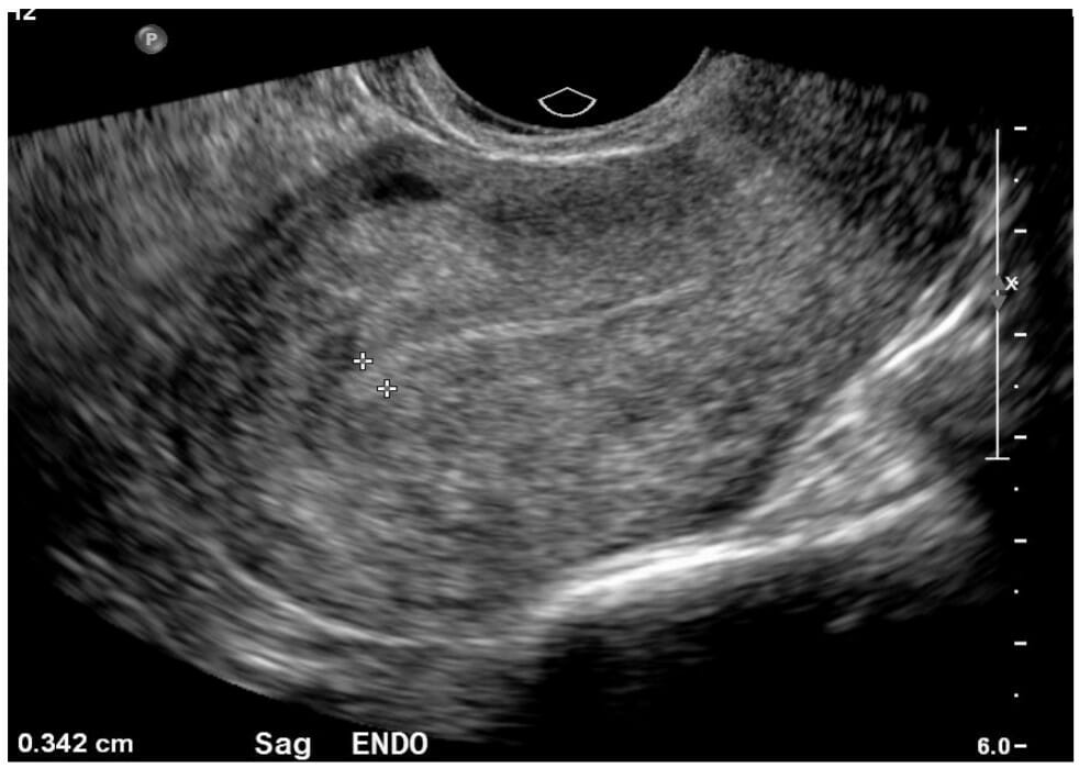 A normal ultrasound image of the uterus in a sagittal view