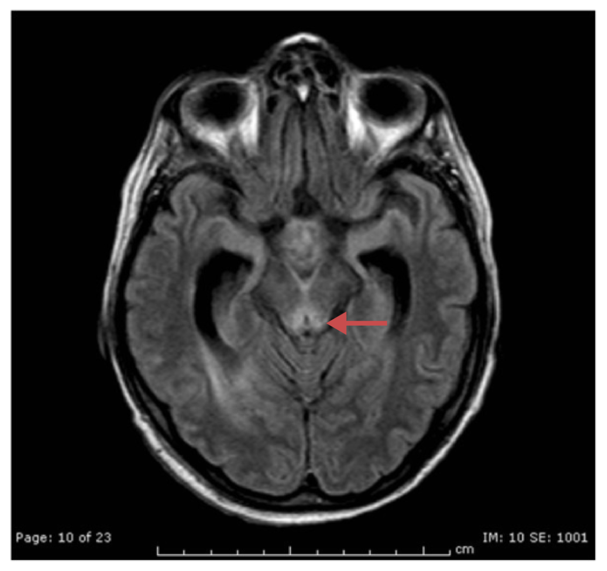 A patient with wernicke encephalopathy showing hyperintensity of the periaqueductal gray substancea patient with wernicke encephalopathy showing hyperintensity of the periaqueductal gray substance