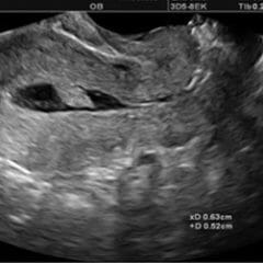 A pedunculated endometrial polyp seen on saline infusion sonogram (SIS)