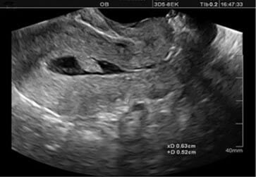Um pólipo endometrial pedunculado visto na ultrassonografia com infusão salina (sis)