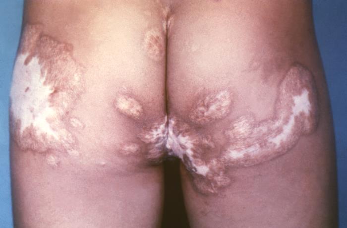 A posterior view of a patient’s torso coccidioidomycosis