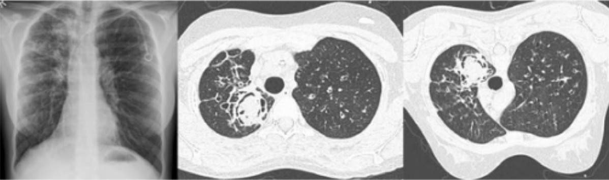 A pulmonary aspergilloma