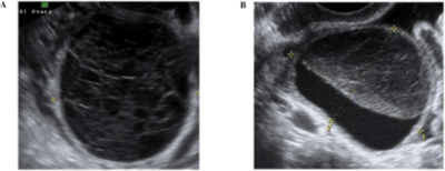 Ovarian Cysts | Concise Medical Knowledge