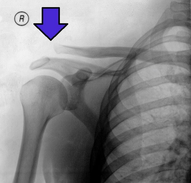 Radiografía de una articulación acromioclavicular separada (realzada)