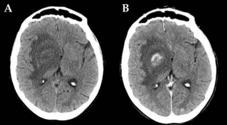Aids-related neuro-toxoplasmosis