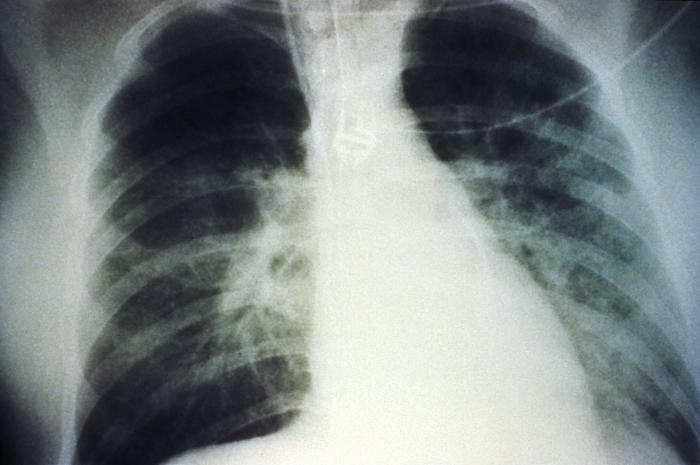 Radiografía de tórax ap síndrome pulmonar por hantavirus bunyavirus