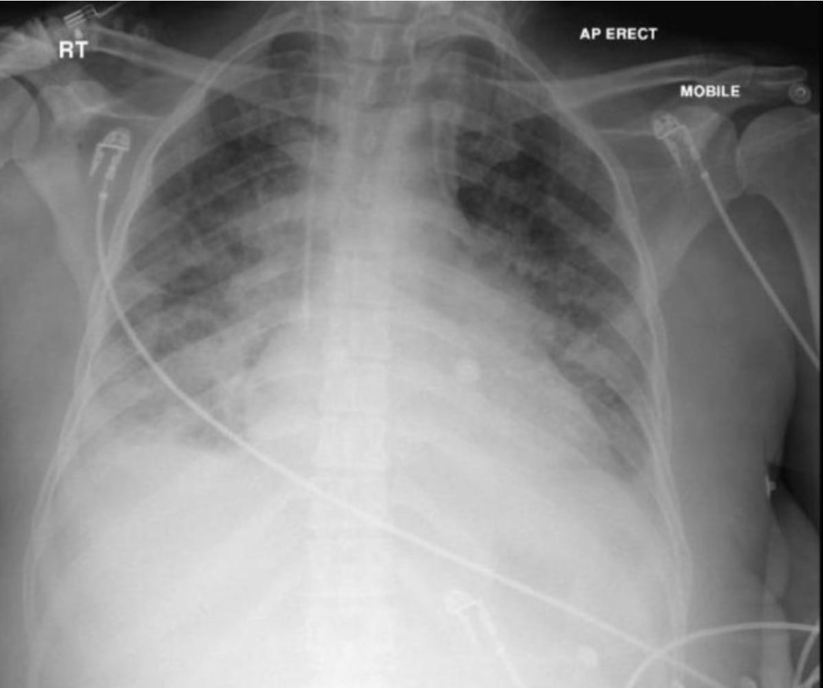 Ards on xray