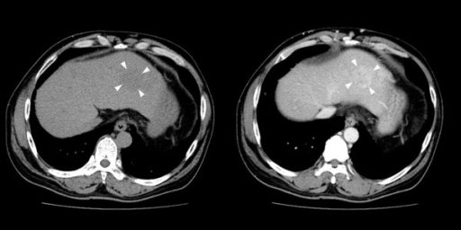 Abdominal ct in an individual with hepatic angiosarcoma
