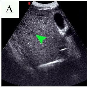Abdominal ultrasound toxocariasis