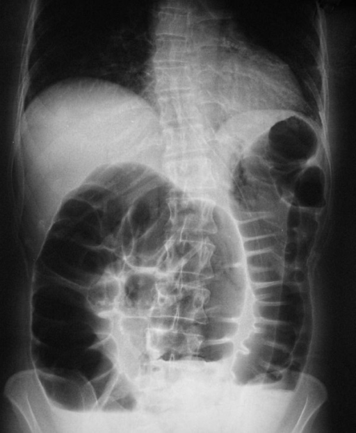 Abdominal x-ray shows dilatation of proximal bowel segments