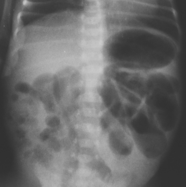 Abdominal radiograph of necrotizing enterocolitis