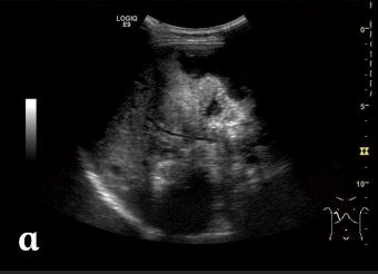 Abdominal ultrasound alveolar echinococcosis echinococcus