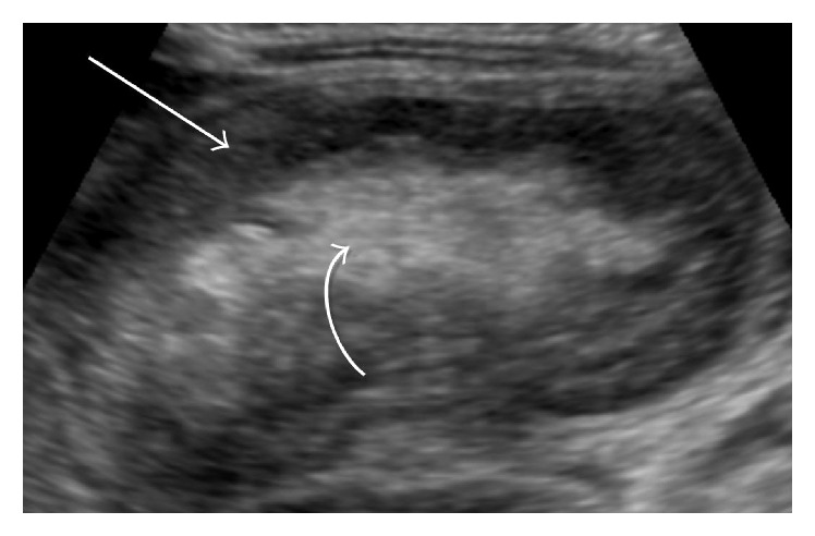 Abdominal ultrasound intussusception