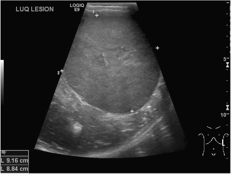 Abdominal ultrasound showing wilms’ tumor