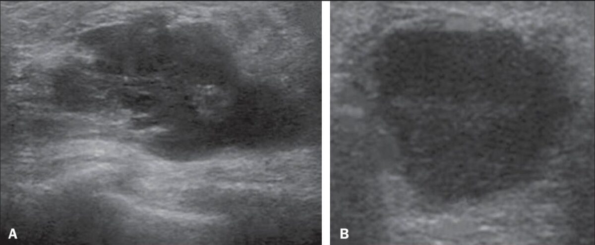 Abscess on ultrasound in diagnosis of mastitis