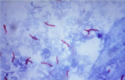 Coloração ácido-resistente de mycobacterium tuberculosis