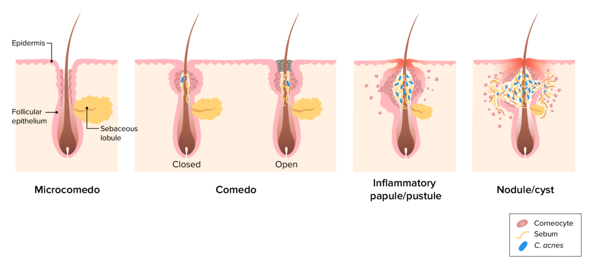 Acne vulgaris pathogenesis illustrated