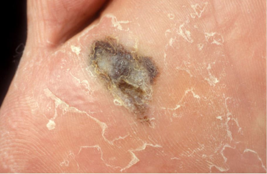 Acral lentiginous melanoma of the foot