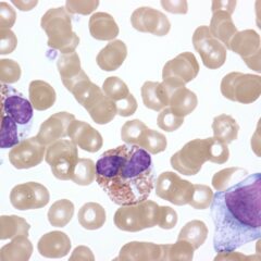 Activated eosinophils in hypereosinophilic syndrome