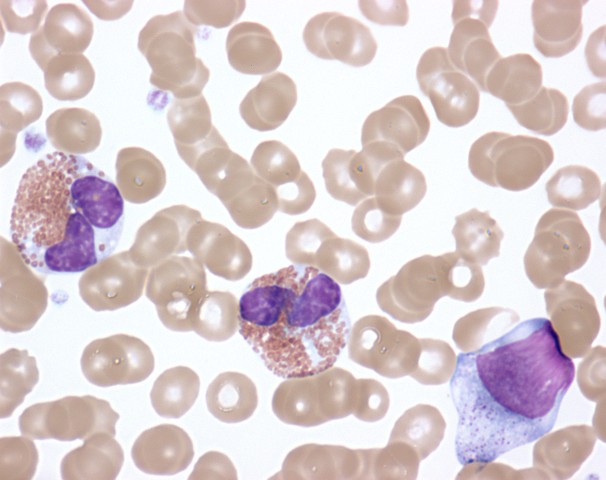 Activated eosinophils in hypereosinophilic syndrome