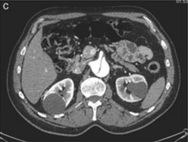Acute abdomen ct - aortic dissection finding
