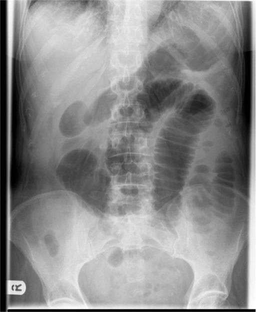 Acute appendicitis presenting as small bowel obstruction